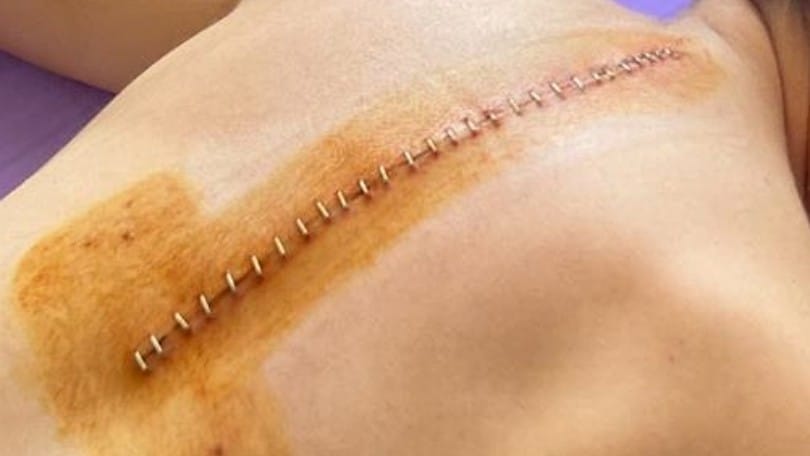 Ana Carrasco mostra l'incredibile cicatrice lasciata dall'intervento alla schiena - FOTO