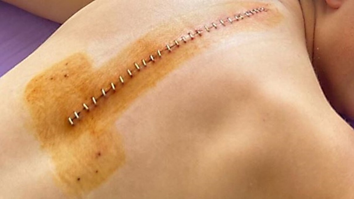 Ana Carrasco: le radiografie dell'intervento - FOTO