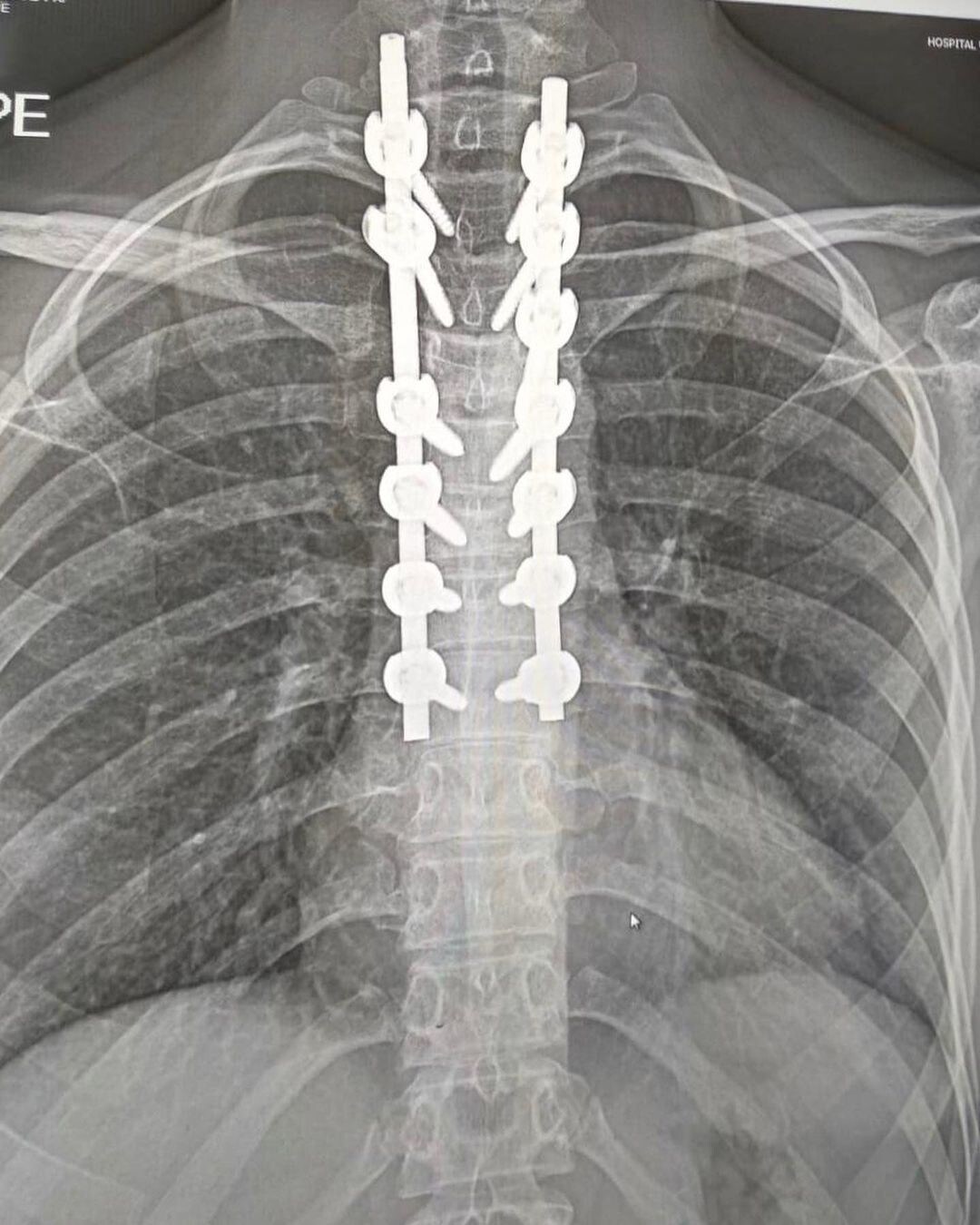 Ana Carrasco: le radiografie dell'intervento - FOTO