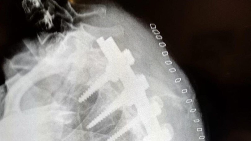 Ana Carrasco: le radiografie dell'intervento - FOTO