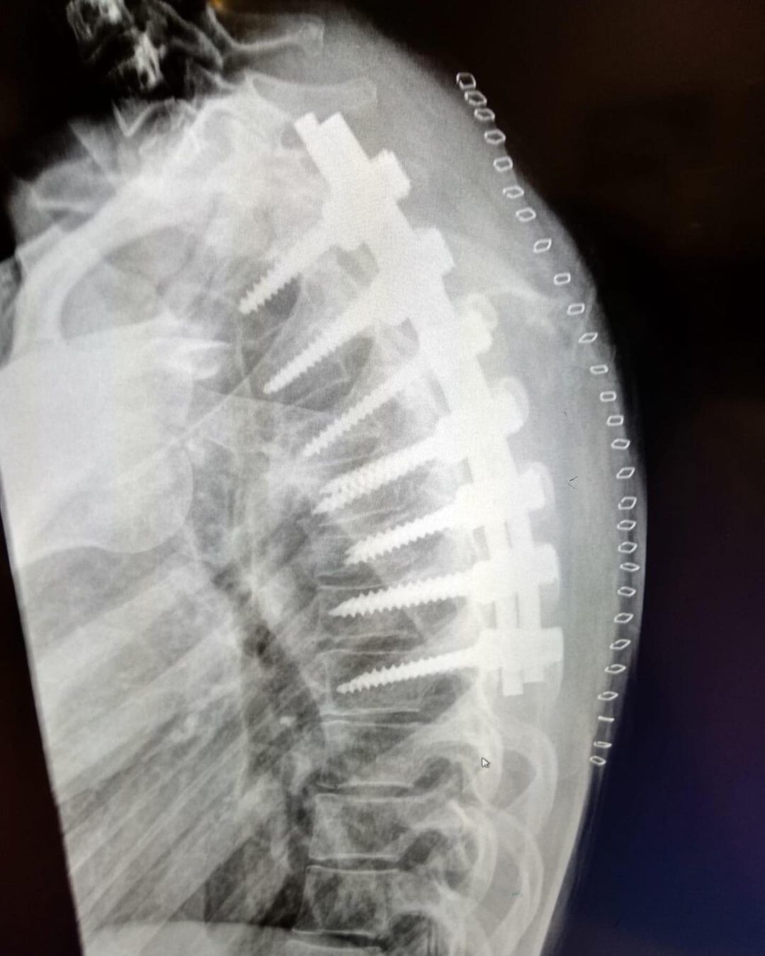 Ana Carrasco: le radiografie dell'intervento - FOTO