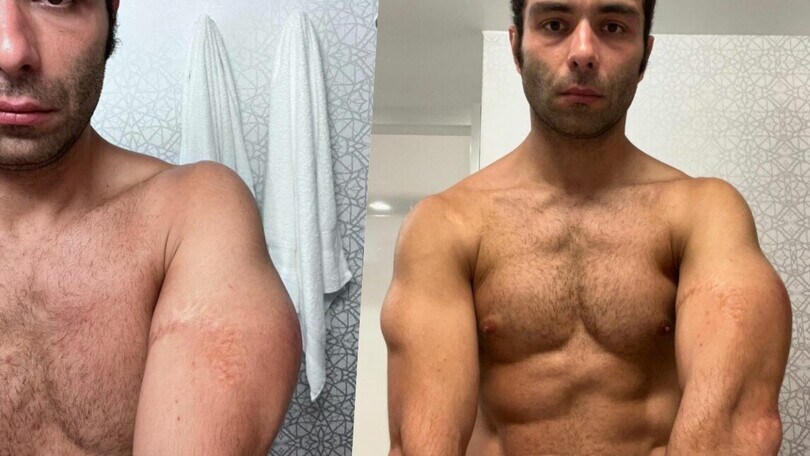 Bruciature ed ematomi: Petrucci mostra i segni dell'incidente in Virginia