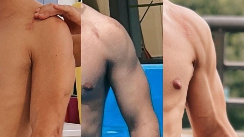 Moto2, Dalla Porta: “Here’s the progress re my injured shoulder”