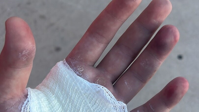 SSP Portimao finita per Spinelli: mano sinistra KO