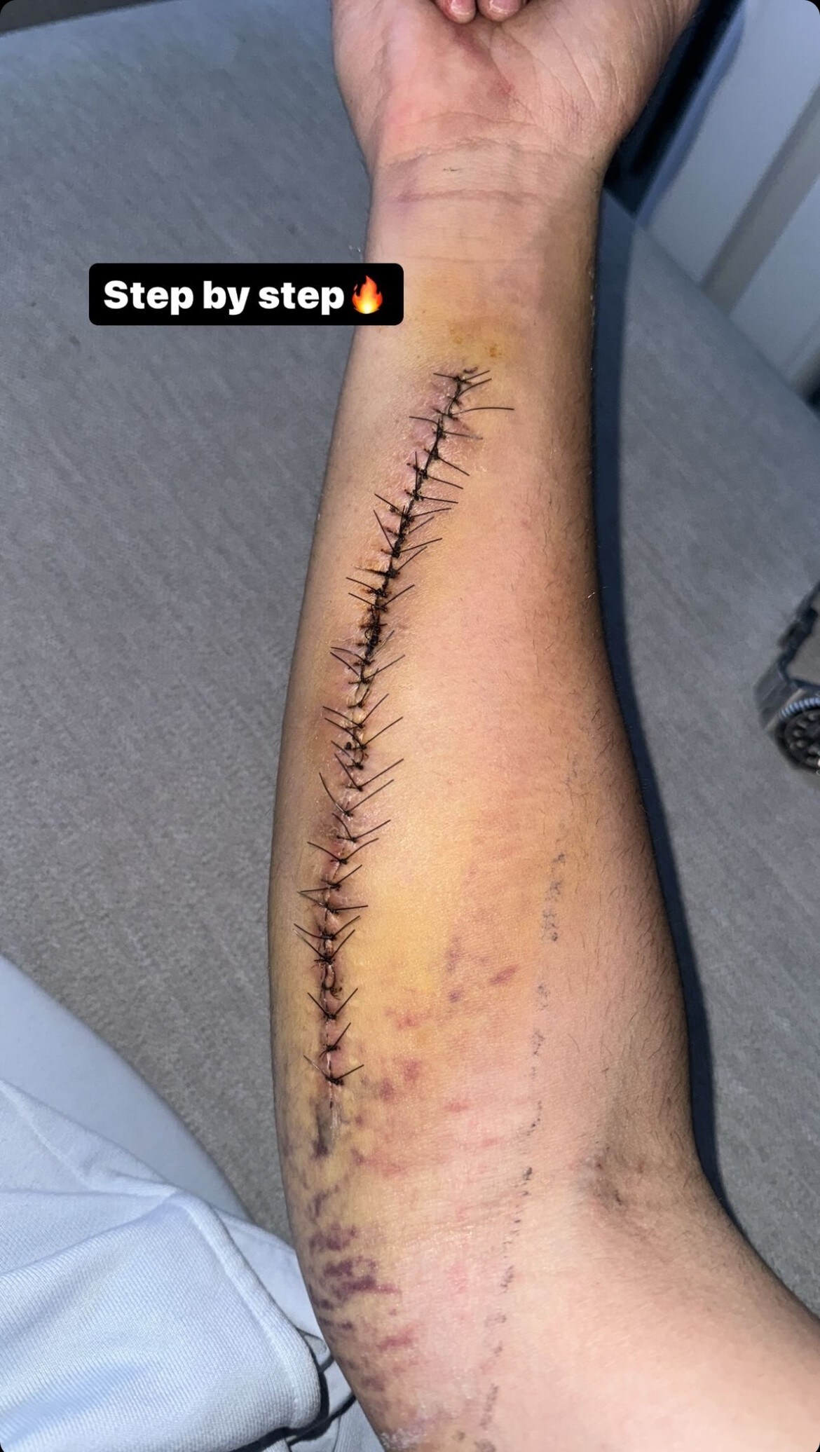 SBK: ecco il braccio di Bulega dopo l'operazione per sindrome compartimentale