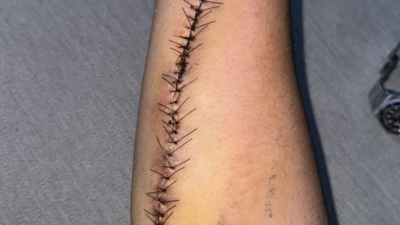 SBK: ecco il braccio di Bulega dopo l'operazione per sindrome compartimentale