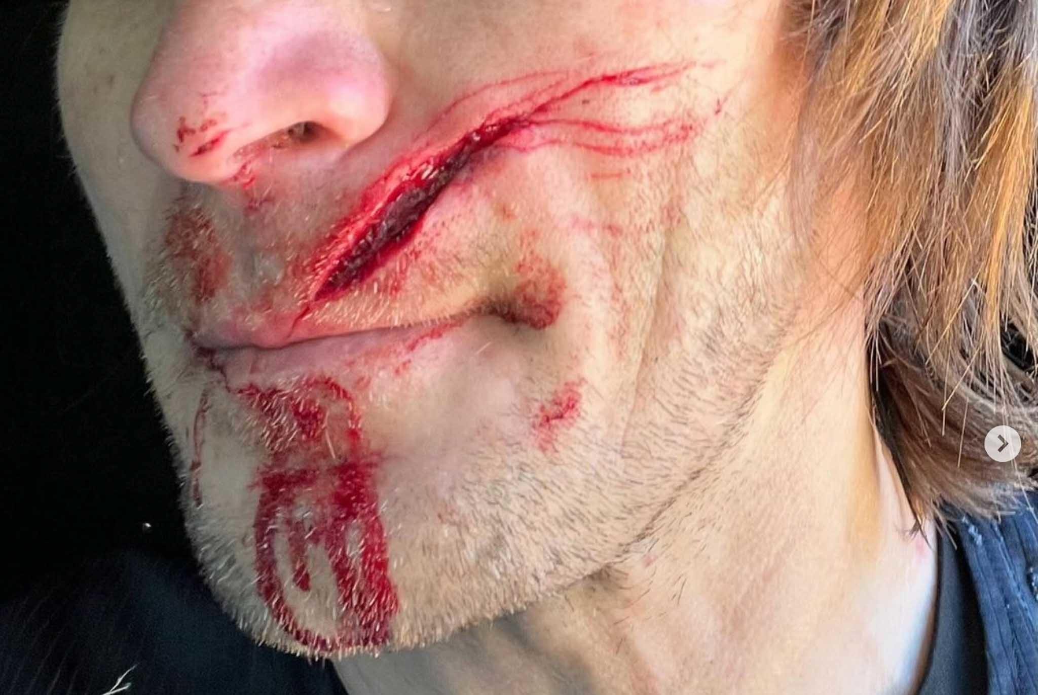 Enduro: Taddy Blazusiak ferito da un cavo