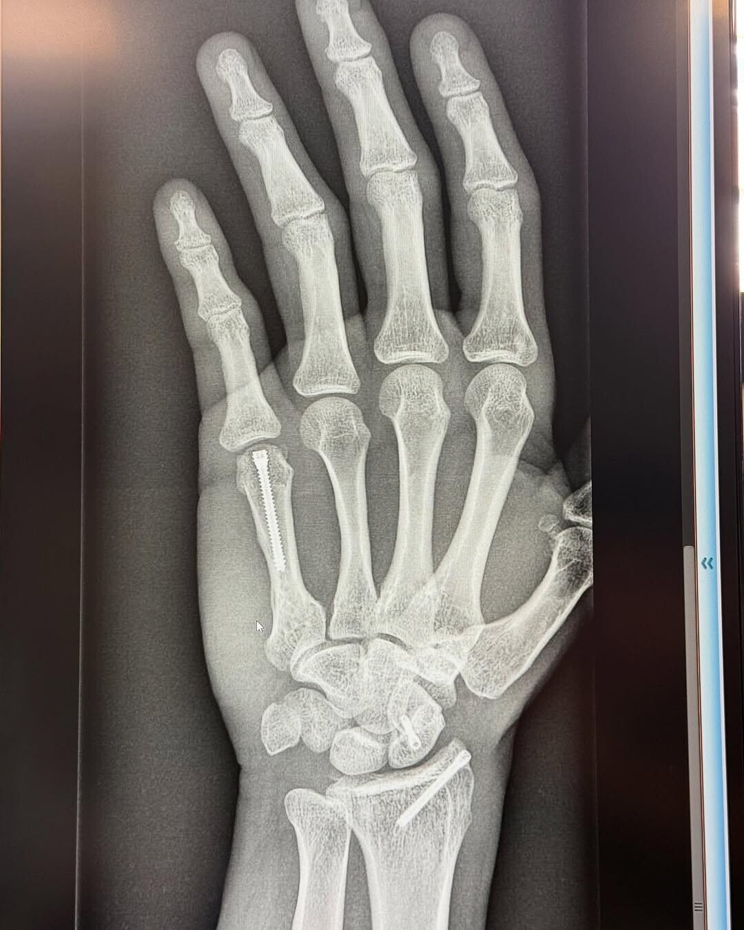 MotoGP, aggiornamento sulle condizioni di Jorge Martin dopo il disastroso incidente