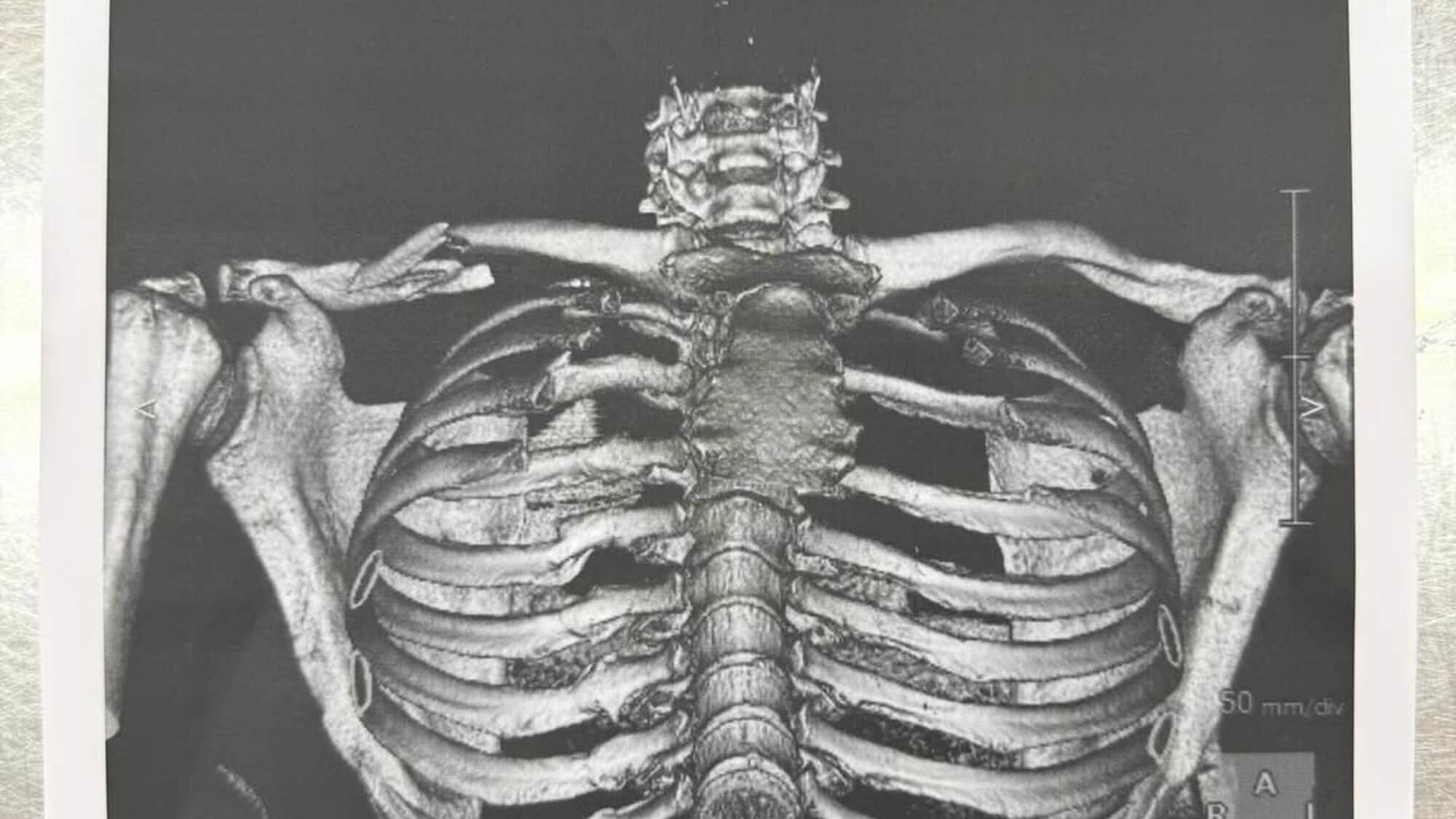 MotoGP, Martin infortunato: ecco l'immagine inedita dell frattura