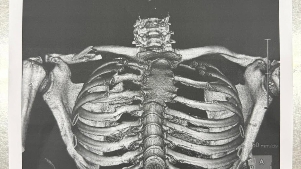 MotoGP, Martin infortunato: ecco l'immagine inedita dell frattura