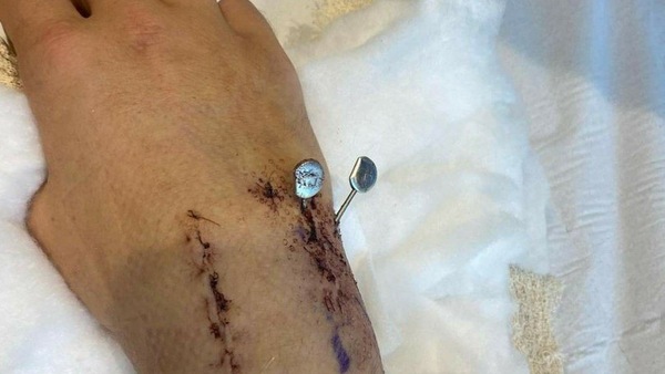 Moto2: le immagini del polso fratturato di Jake Dixon