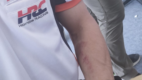MotoGP, Marc Marquez: “Il segno sul braccio? Non è l'unico che ho”