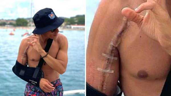 MotoGP, Marc Marquez mostra la cicatrice: immagini da spavento