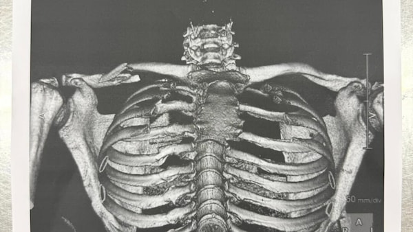 MotoGP, Martin infortunato: ecco l'immagine inedita dell frattura