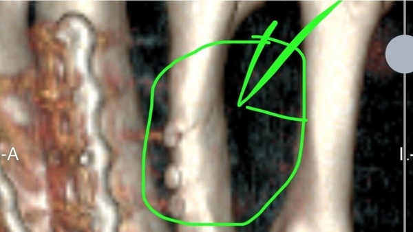 SBK, Petrucci infortunato a Estoril: “Proverò a correre”